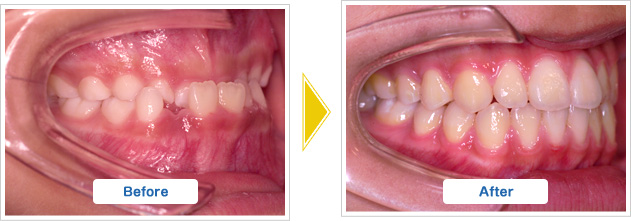 下顎前突、受け口の治療前と治療後の様子