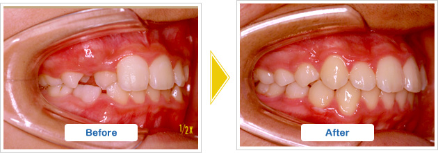 乱杭歯、叢生の治療前と治療後の様子