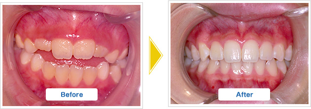 開口矯正の治療前と治療後の様子