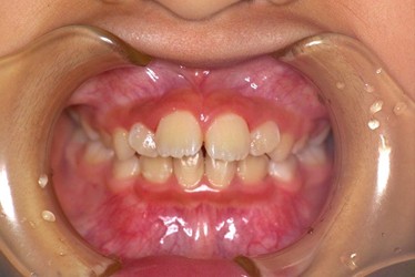 骨格性上顎前突ビフォー