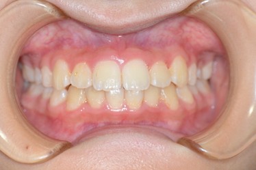 骨格性上顎前突アフター